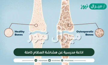 اذاعة مدرسية عن هشاشة العظام كاملة