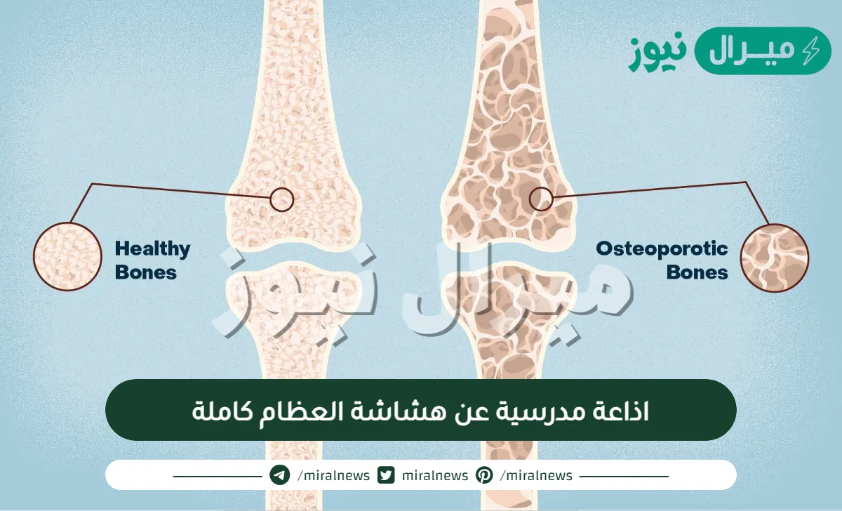 اذاعة مدرسية عن هشاشة العظام كاملة