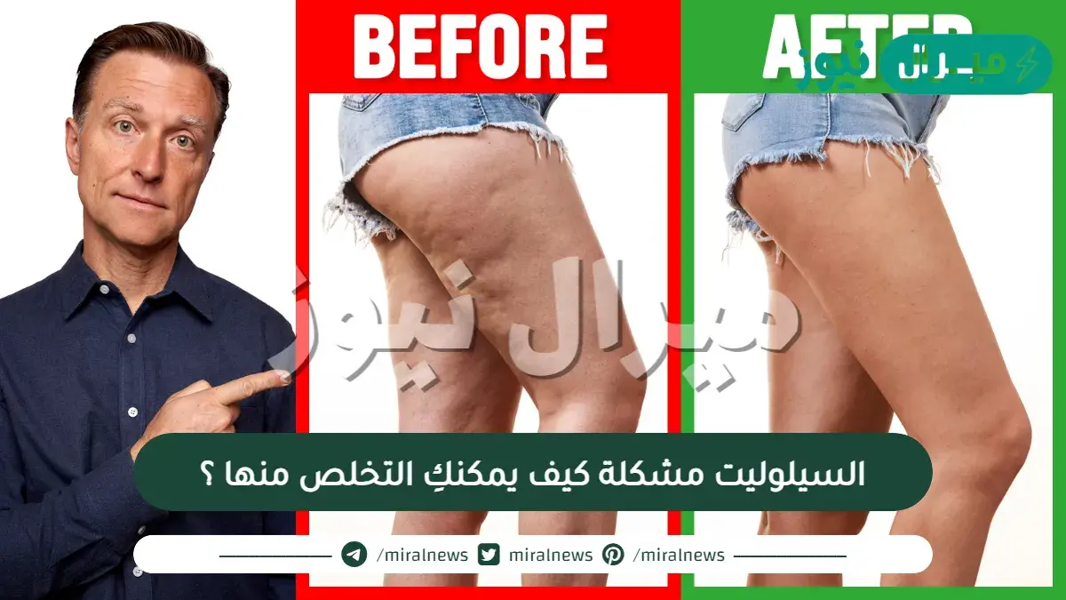 السيلوليت مشكلة كيف يمكنكِ التخلص منها ؟