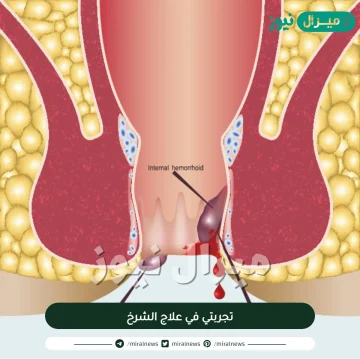 تجربتي في علاج الشرخ وكيف يتم علاجه