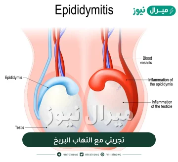 تجربتي مع التهاب البربخ وكيف شفيت منه ؟