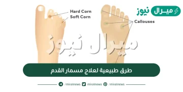 طرق طبيعية لعلاج مسمار القدم