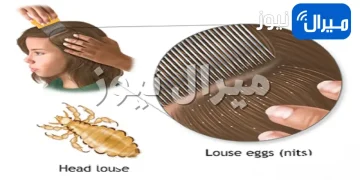 طرق منزلية للتخلص من حشرات الرأس نهائيًا