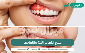 علاج التهاب اللثة وانتفاخها