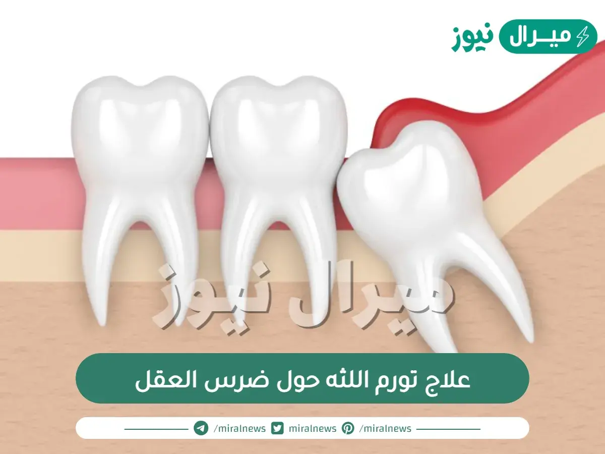 علاج تورم اللثه حول ضرس العقل