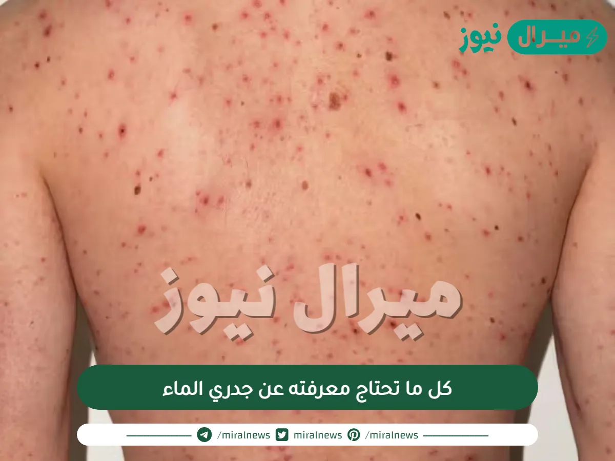 كل ما تحتاج معرفته عن جدري الماء
