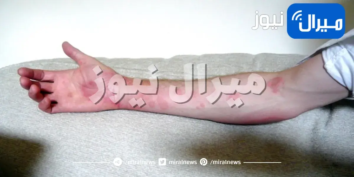 كل ما يجب أن تعرفه عن الشرى المزمن (الأرتكاريا)