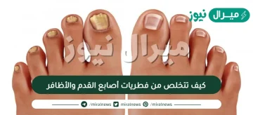 كيف تتخلص من فطريات أصابع القدم والأظافر
