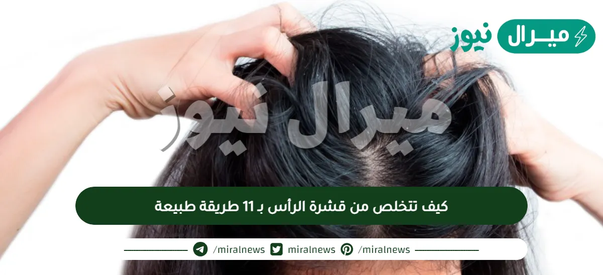 كيف تتخلص من قشرة الرأس بـ 11 طريقة طبيعة
