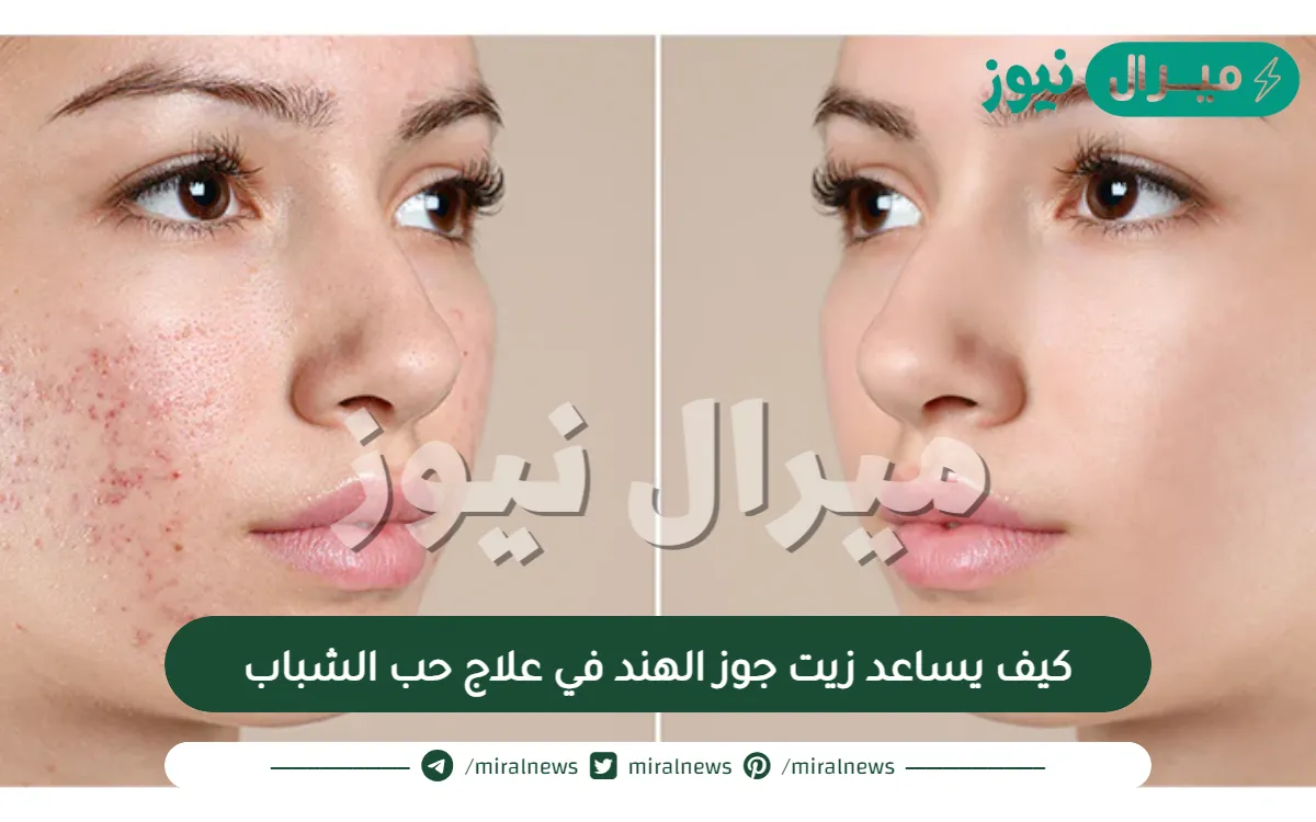 كيف يساعد زيت جوز الهند في علاج حب الشباب