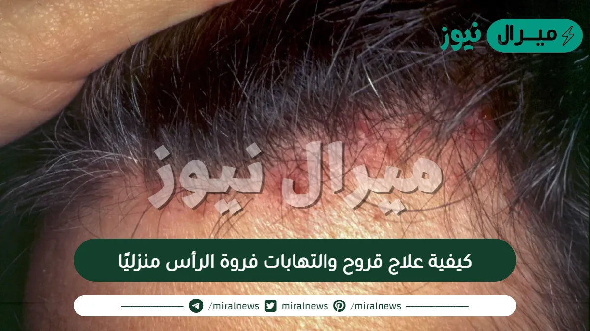 كيفية علاج قروح والتهابات فروة الرأس منزليًا