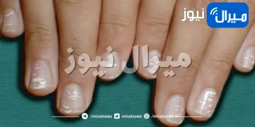 لماذا توجد بقع بيضاء على أظافري