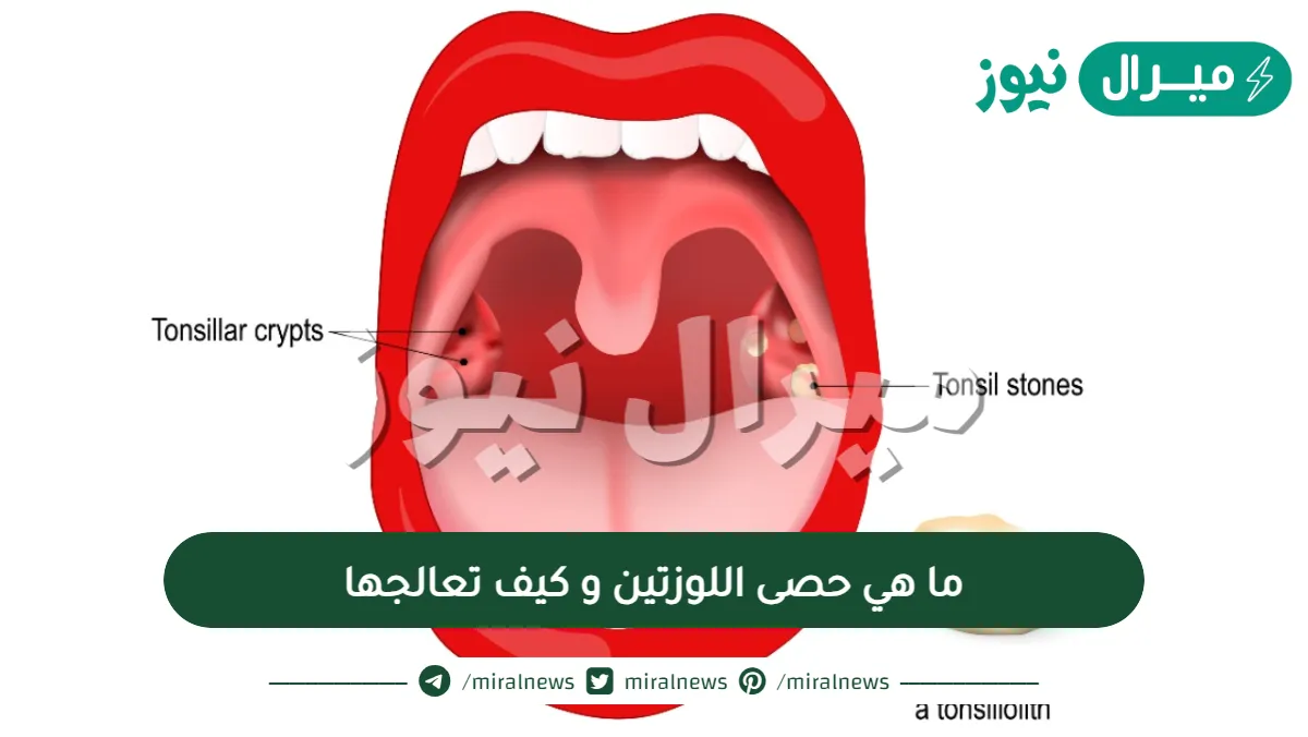 ما هي حصى اللوزتين و كيف تعالجها