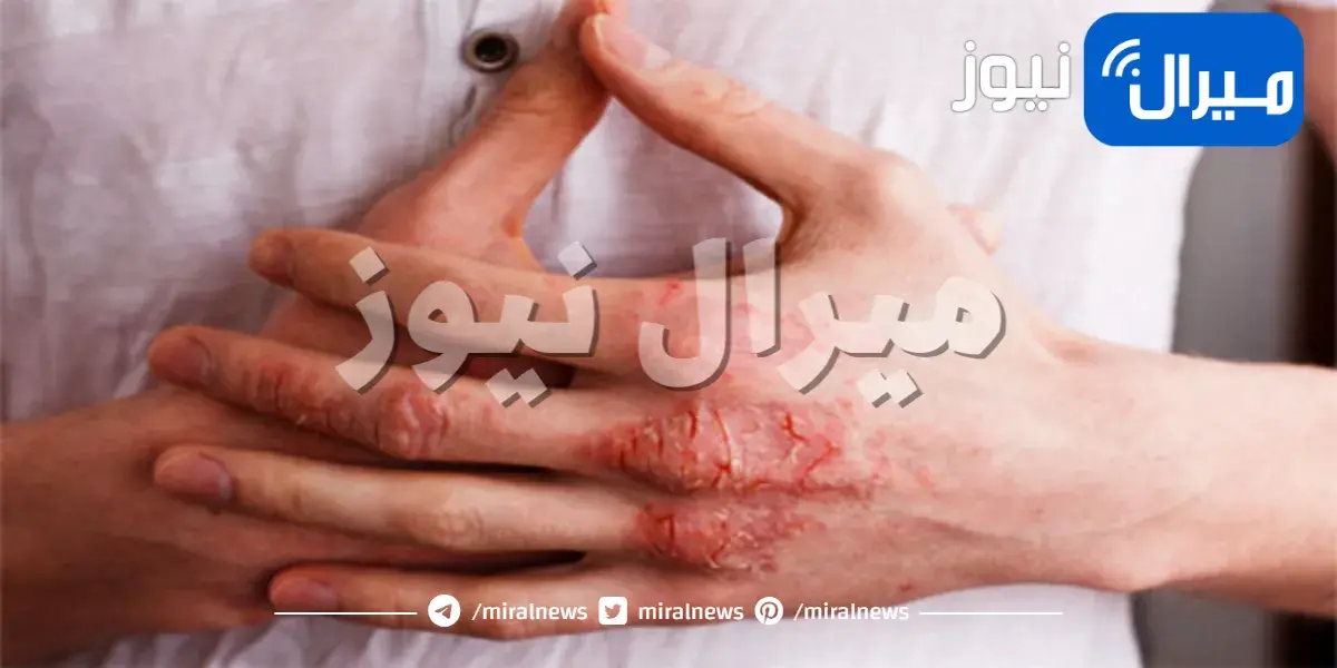 ما يجب أن تعرفه عن الإكزيما