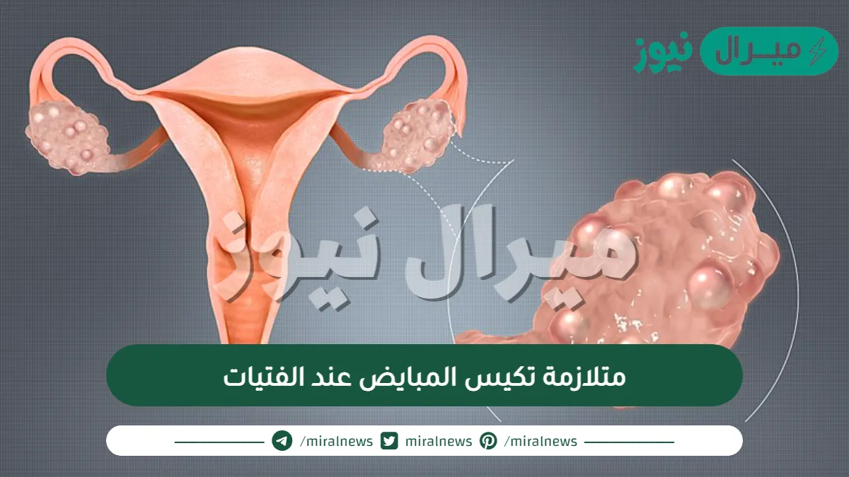 متلازمة تكيس المبايض عند الفتيات