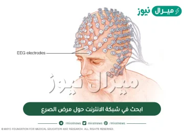 ابحث في شبكة الانترنت حول مرض الصرع