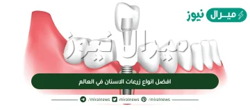 افضل انواع زرعات الاسنان في العالم واهم نصائح للزراعة