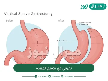 تجربتي مع تكميم المعدة