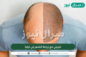 تجربتي مع زراعة الشعر في تركيا | تقنية السفير لزاعة الشعر