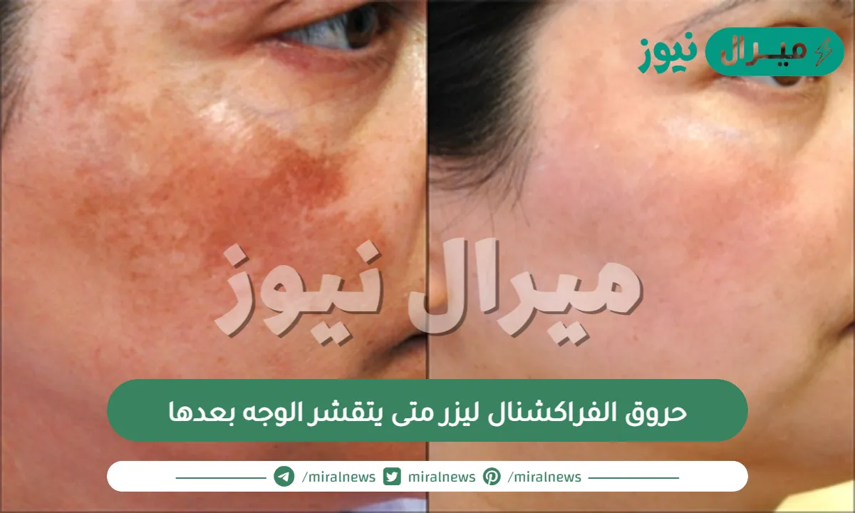حروق الفراكشنال ليزر ومتى يتقشر الوجه بعدها