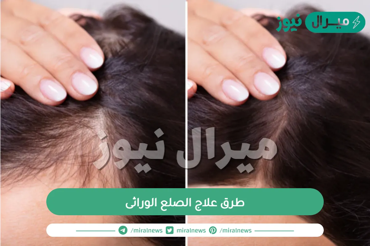 طرق علاج الصلع الوراثى