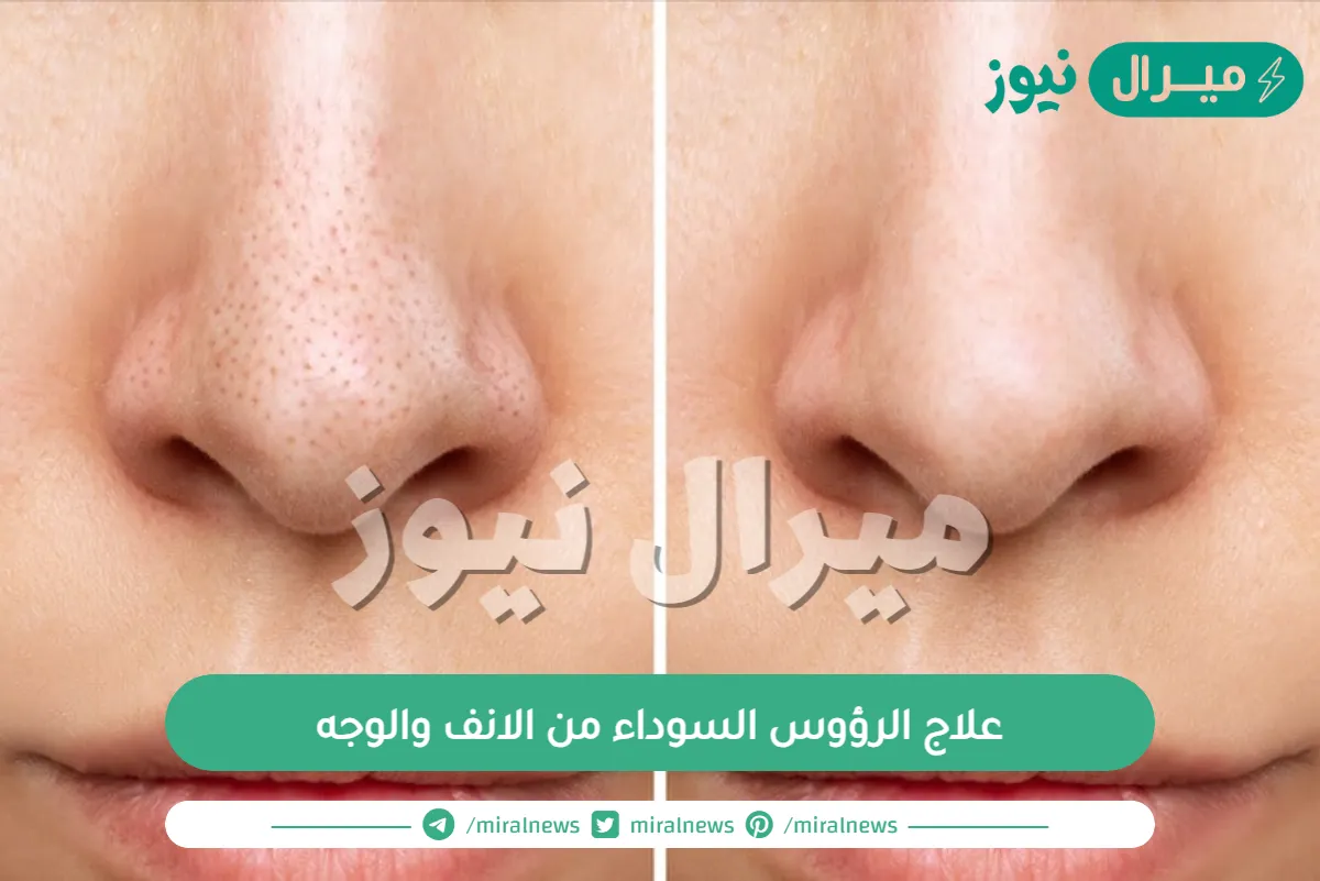 علاج الرؤوس السوداء من الانف والوجه