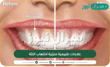علاجات طبيعية منزلية لالتهاب اللثة