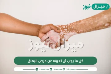 كل ما يجب أن تعرفه عن مرض البهاق