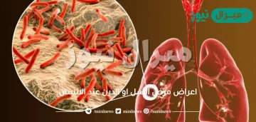 اعراض مرض السل او الدرن عند الانسان