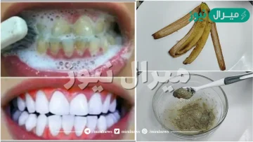 “إعملها قبل النوم” .. طريقة أغلى من الذهب لتبييض الأسنان بقشر الموز مش هترميه بعد النهاردة