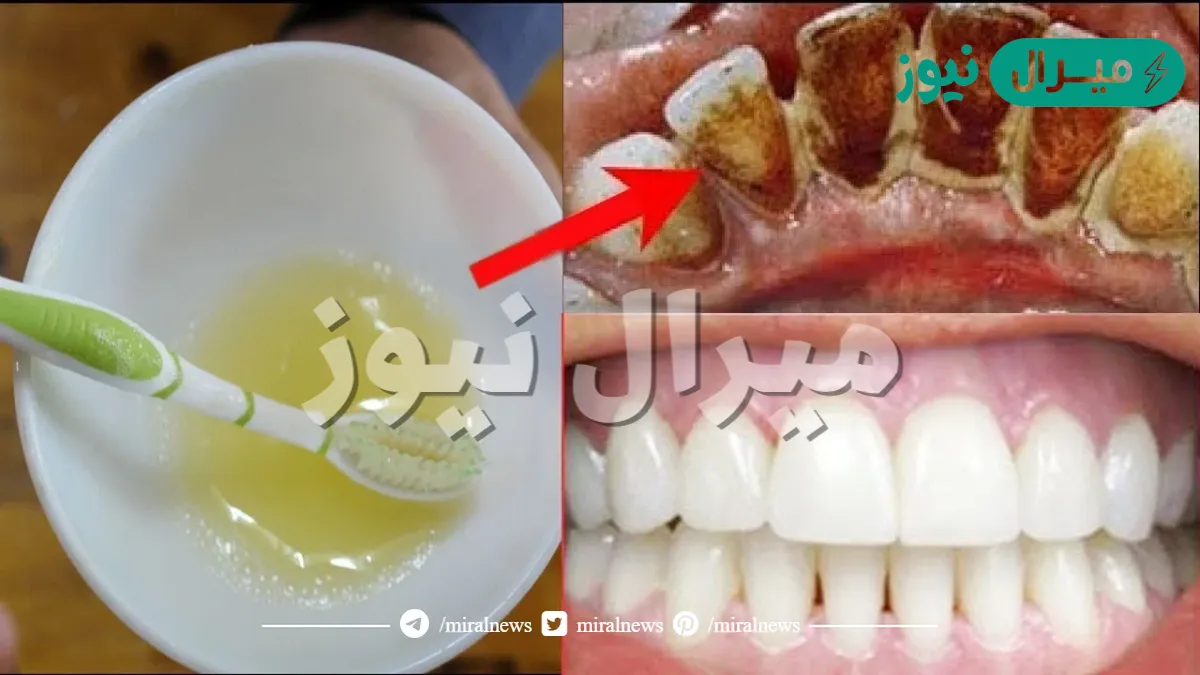 هتسحري الكل ببياض اسنانك.. تبييض الاسنان كاللؤلؤ في 5 دقائق ازالة الجير والتكلس والتسوس نهائيا