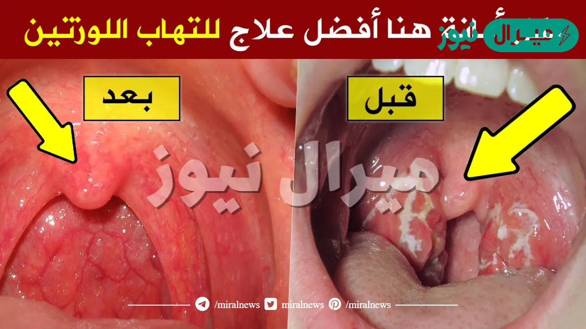 احدث علاج التهاب الحلق في الشتاء 5 وصفات طبيعية ومشروبات لعلاج احتقان الحلق