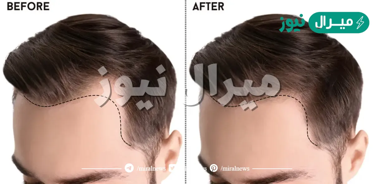 ما هو افضل مركز لزراعة الشعر في تركيا بأقل تكلفة