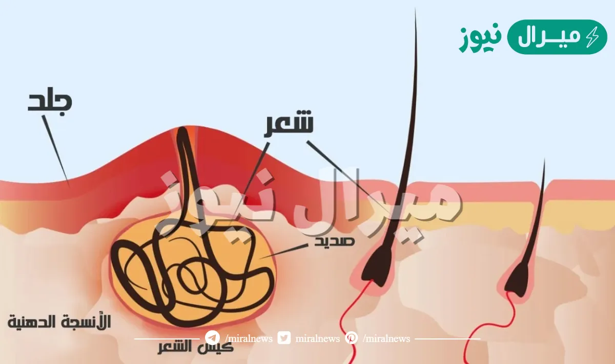 ما هو الناسور العصعصي وطرق الوقاية منه