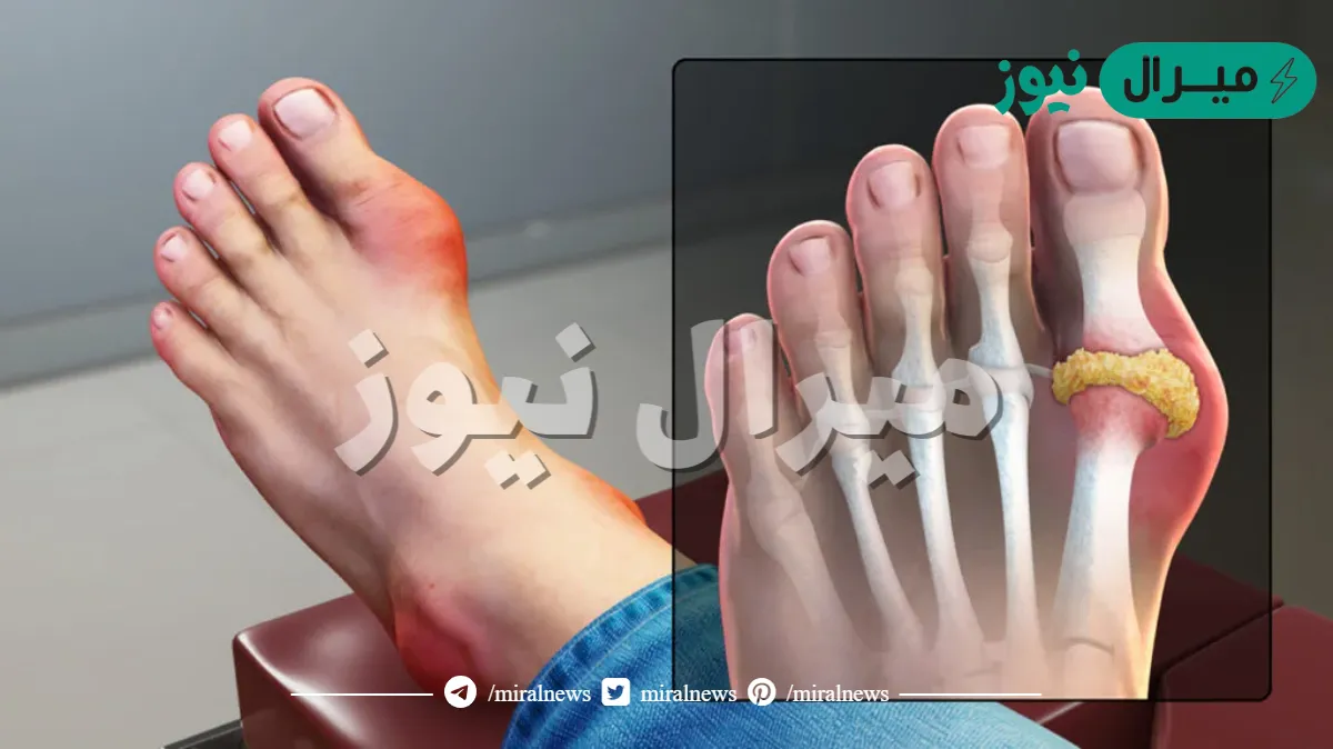 ما هو مرض النقرس