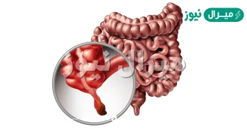 ما هي الزائدة الدودية