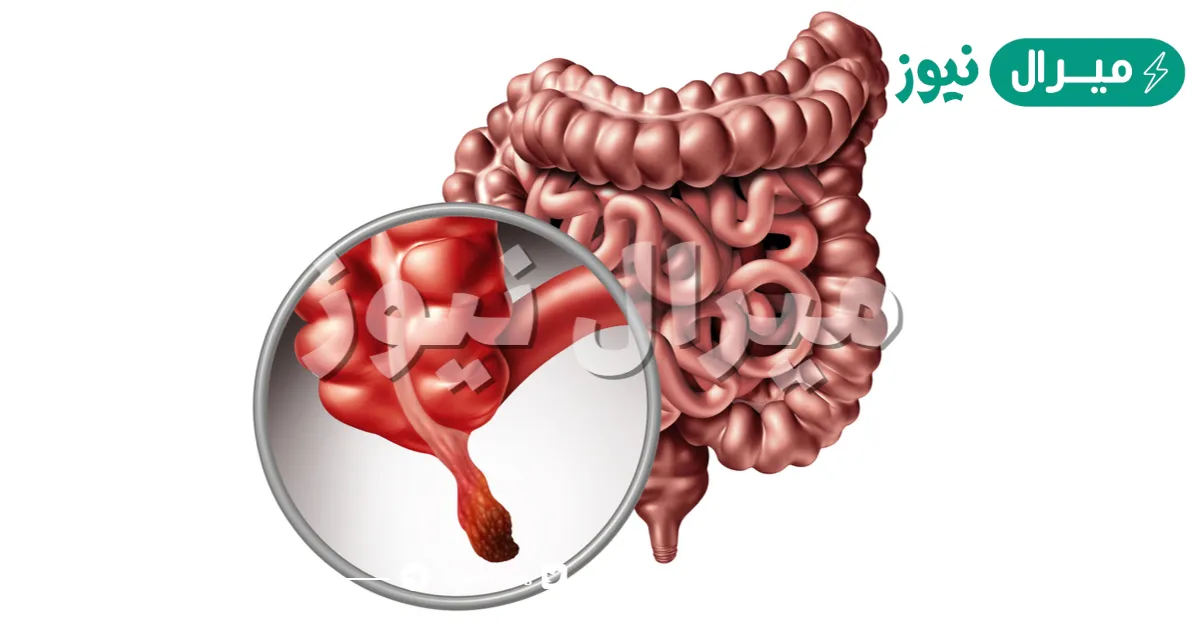 ما هي الزائدة الدودية