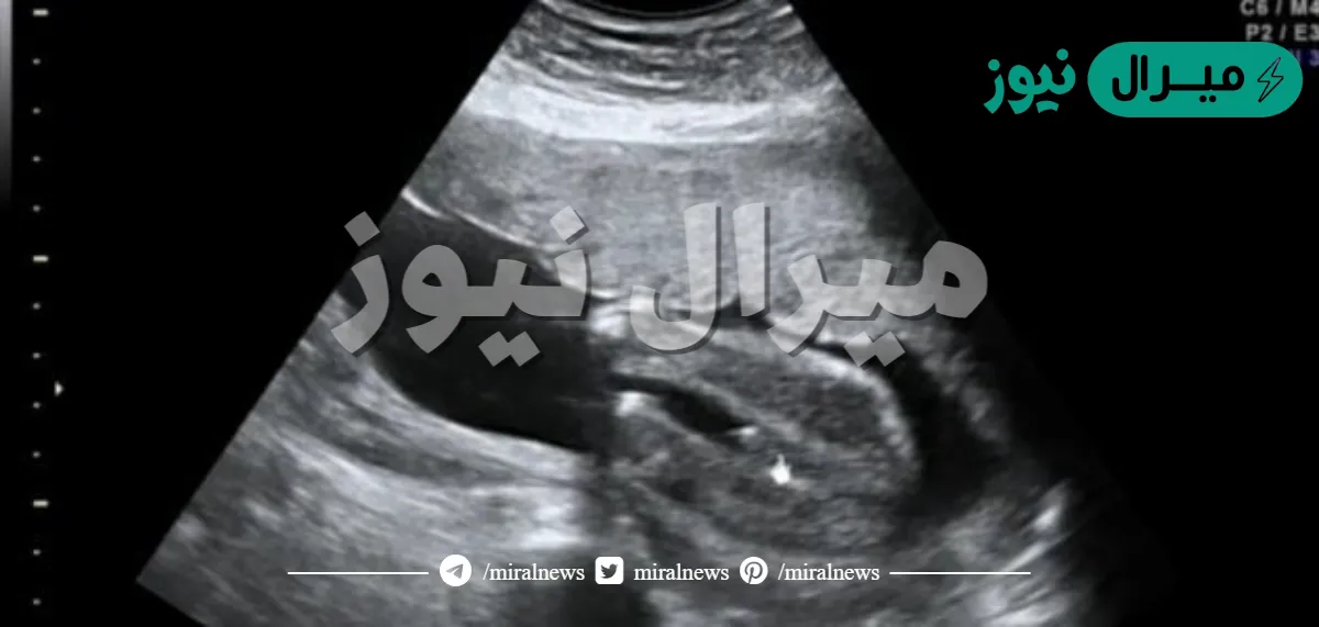 متى يبين جنس الجنين