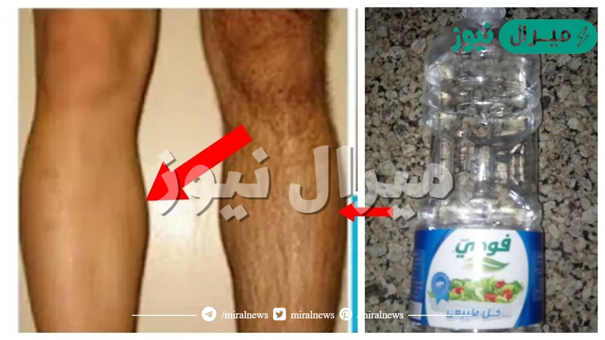 إزالة الشعر بالخل وصفة جبارة للتخلص من الشعر الزائد بدون حك أو ألم