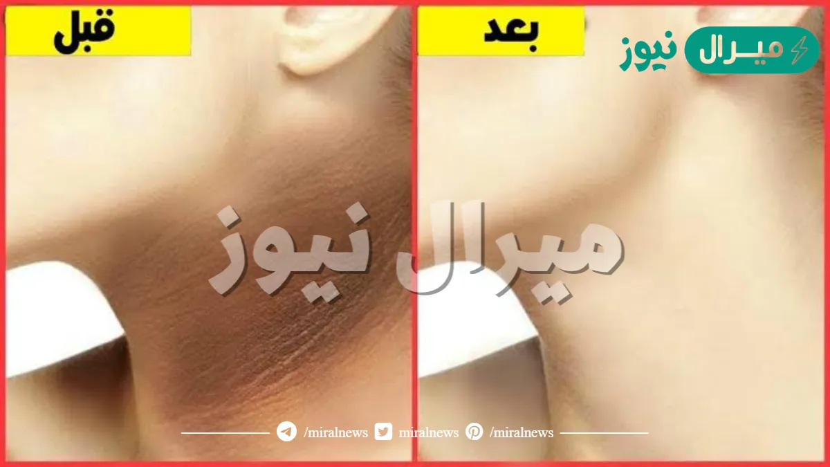 وصفة تبييض الرقبة والكوع ضعي هذه الخلطة ربع ساعه فقط وسيختفي السواد نهائيا