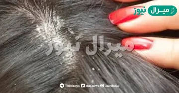 تفسير حلم القمل في الشعر للبنت في المنام لابن سيرين وابن شاهين والنابلسي