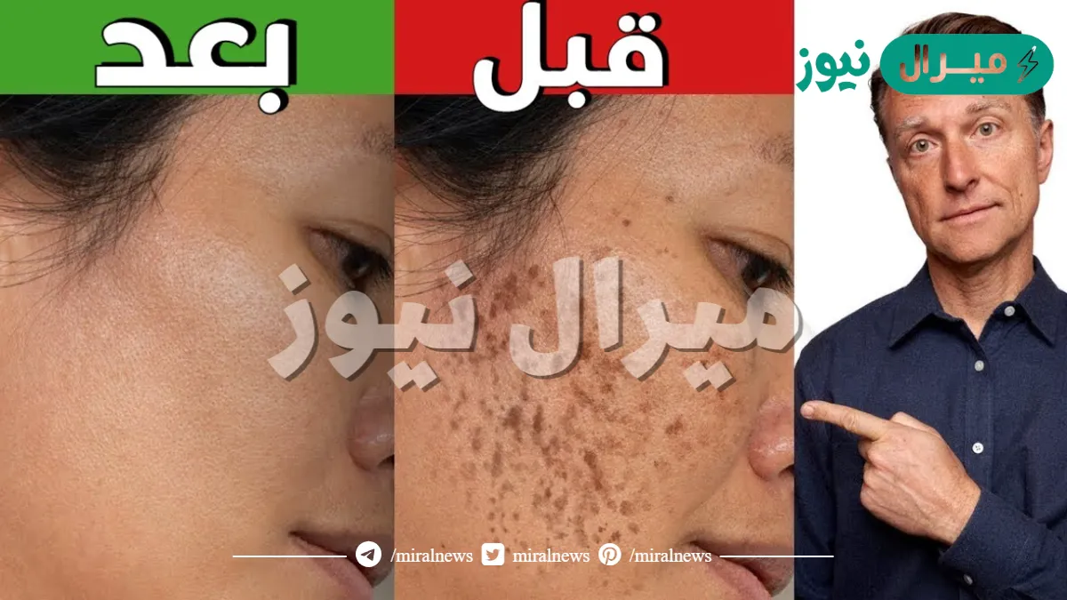 علاج التَّصَبُّغَات الجلدية العميقة والكلف بالأعشاب بدون الحاجة للمواد الكيميائية