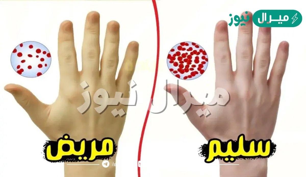 اعراض فقر الدم الحاد عند النساء