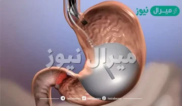 تجربتي مع بالون المعدة للتنحيف والتخلص من الوزن الزائد