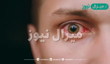 سبب احمرار العين