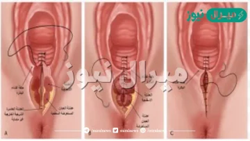 شكل الخياطه بعد الولاده الطبيعيه بالصور