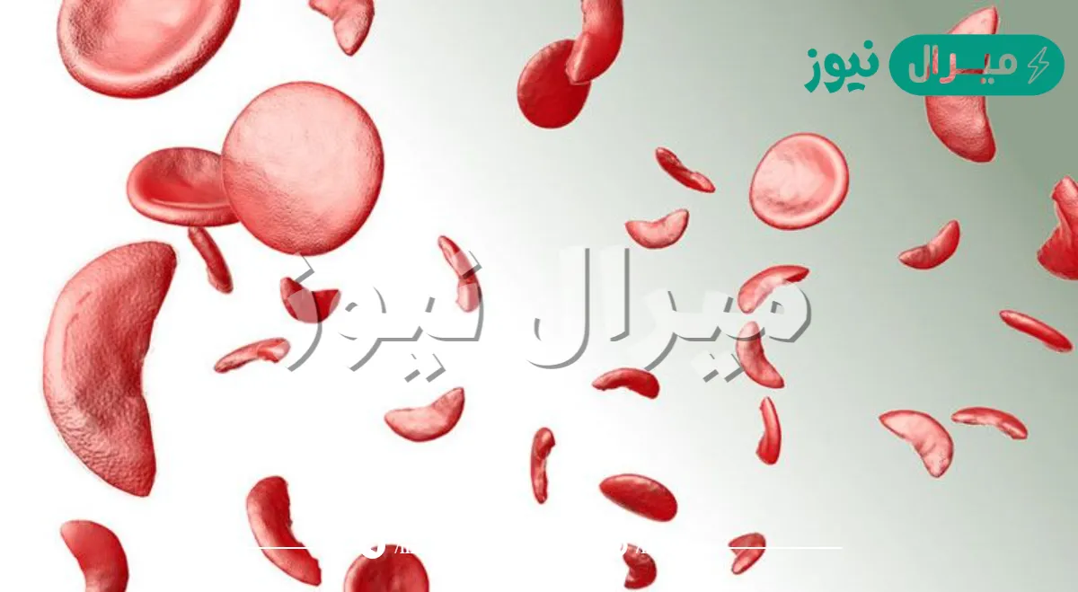 علاج الانيميا المنجلية عند الاطفال