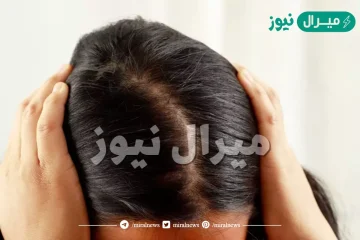 علاج الصلع الوراثى عند النساء