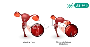 علاج ميلان الرحم بالطب الشعبي وأسبابه وأهم المعلومات حوله