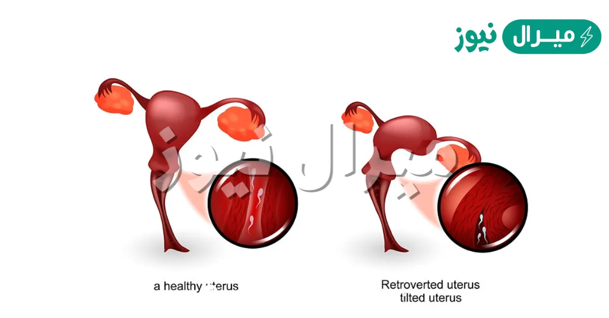علاج ميلان الرحم بالطب الشعبي وأسبابه وأهم المعلومات حوله